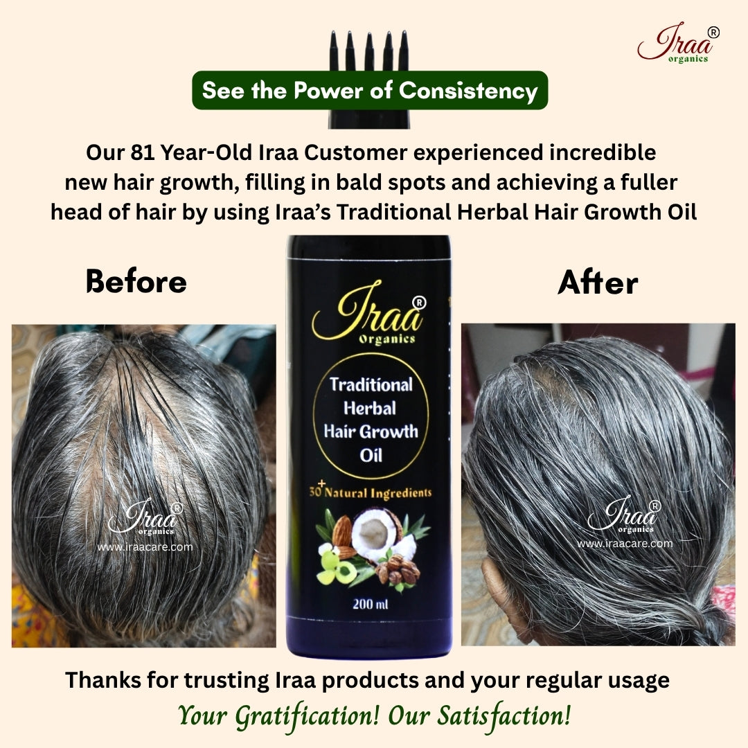 Best Hair Growth Oil - Fast New Hair Growth in 45 days. – Iraa Organics